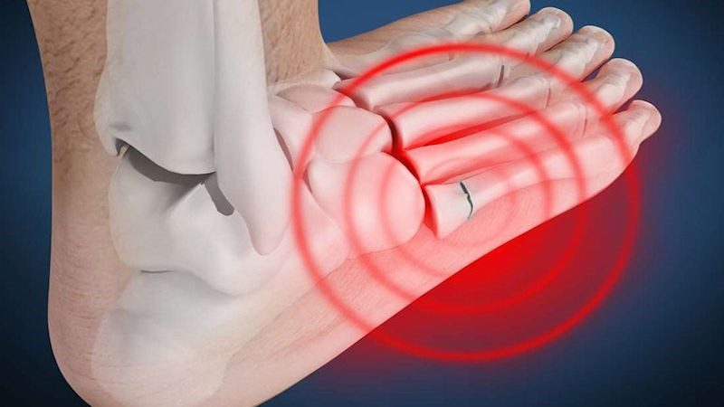 Vì sao tổn thương stress xương ghe đáng lo ngại?